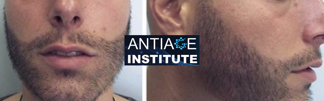 Trapianto barba Siracusa Antiage Institute